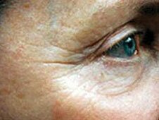 Eye Dermapen treatment before