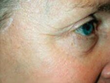 Eye Dermapen treatment after