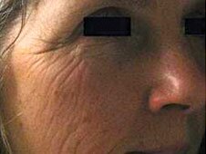 Facial Dermapen treatment before