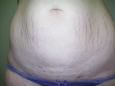 Stomach Dermapen treatment before